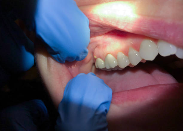 Best Emergency Dental Care for Abscessed Tooth in Raymond, WI
